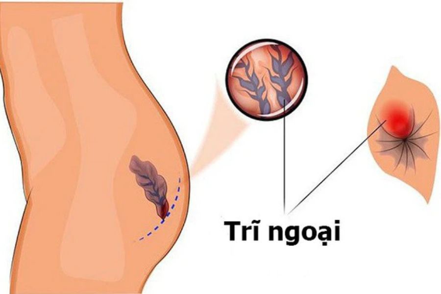 Trĩ ngoại là tình trạng các mạch máu dưới da quanh hậu môn bị sưng giãn, hình thành búi trĩ bên ngoài