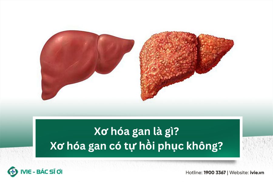 Xơ hóa gan là gì? Xơ hóa gan có tự hồi phục không?