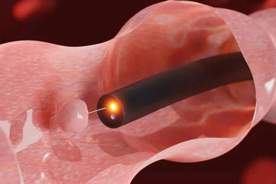 Thời gian hồi phục sau cắt polyp đại tràng tùy thuộc kích thước polyp, phương pháp can thiệp và sức khỏe người bệnh