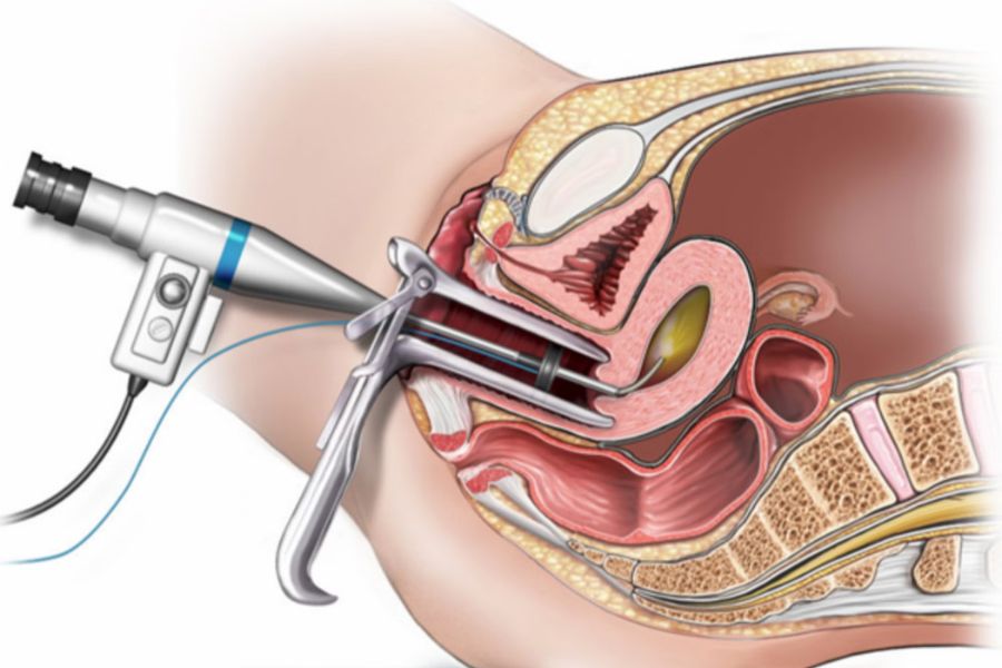 Sau cắt polyp cổ tử cung, cần tái khám đúng hẹn và theo dõi các dấu hiệu bất thường