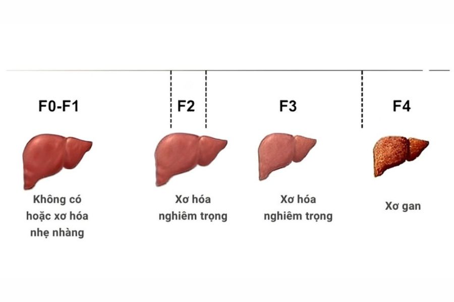 Xơ hóa gan được phân mức từ F1 (nhẹ) đến F4 (xơ gan), phản ánh mức độ hình thành và lan rộng của mô sẹo trong gan