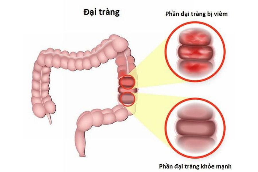 Viêm loét đại tràng (UC) là bệnh viêm ruột mạn tính gây viêm và loét niêm mạc đại tràng, trực tràng