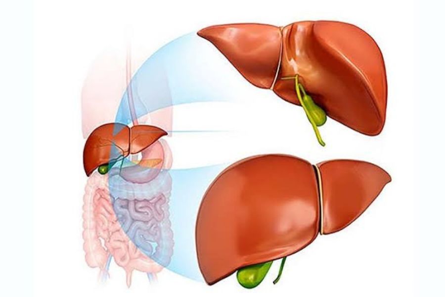 Bilirubin tăng cao có thể do bệnh gan mật, tan máu, rối loạn chuyển hóa bilirubin hoặc tác dụng của một số loại thuốc