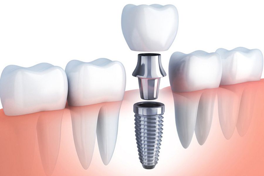 Đa dạng các dòng trụ Implant chính hãng từ Hàn Quốc, Mỹ, Pháp đáp ứng linh hoạt nhu cầu của từng khách hàng