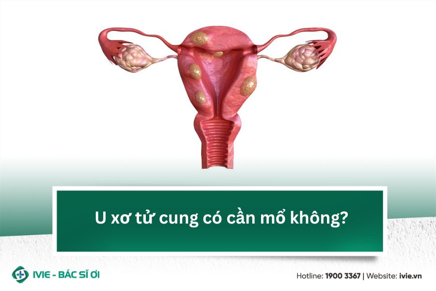 U xơ tử cung có cần mổ không?