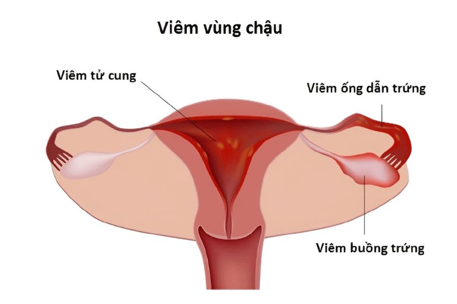 Tổn thương ống dẫn trứng do viêm vùng chậu là nguyên nhân hàng đầu gây cản trở khả năng làm mẹ tự nhiên