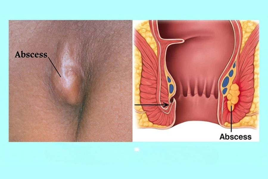 Khái niệm áp xe hậu môn và các khoang tích tụ mủ phổ biến quanh vùng trực tràng - hậu môn