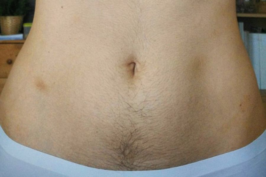 Kinh nguyệt không đều, rậm lông và mụn dai dẳng có thể là dấu hiệu buồng trứng đa nang