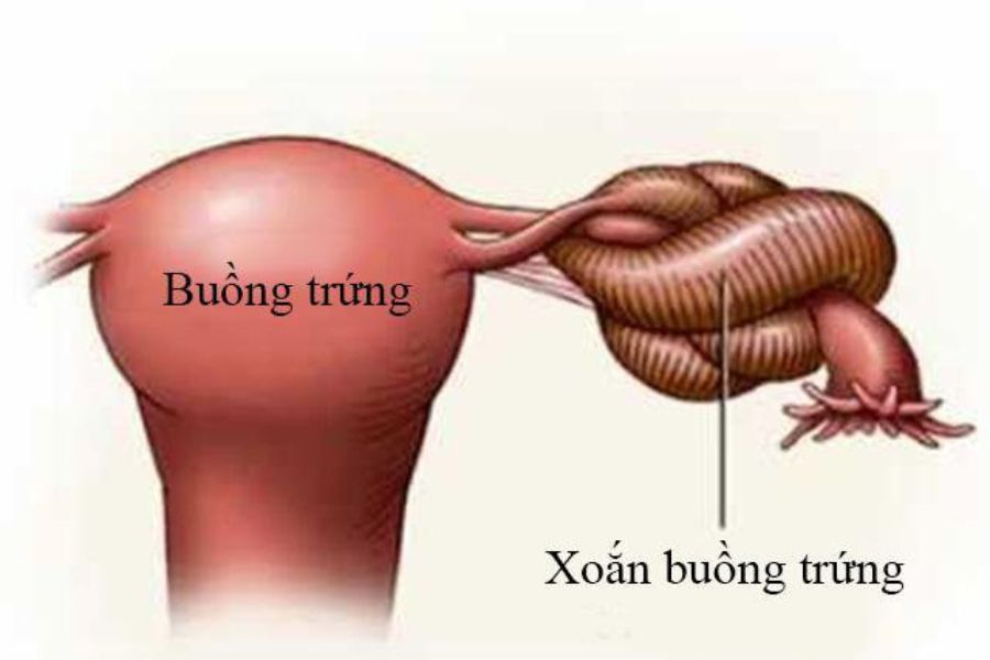Khối u nang buồng trứng có cuống dài và kích thước vừa phải rất dễ bị xoắn khi thay đổi tư thế đột ngột