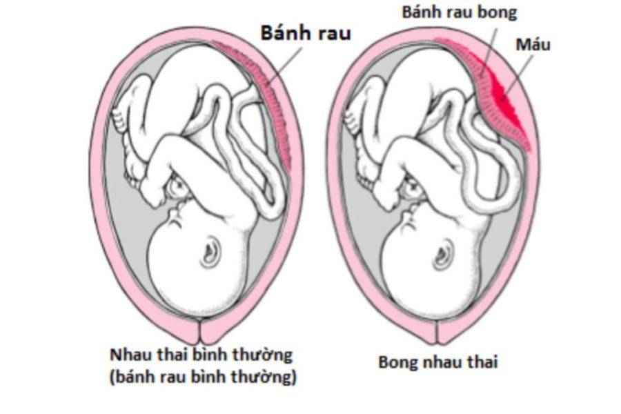 Nhau bong non tạo khối máu tụ sau bánh nhau, cắt đứt nguồn nuôi dưỡng thai nhi