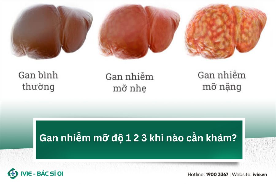 Gan nhiễm mỡ độ 1 2 3 khi nào cần khám?