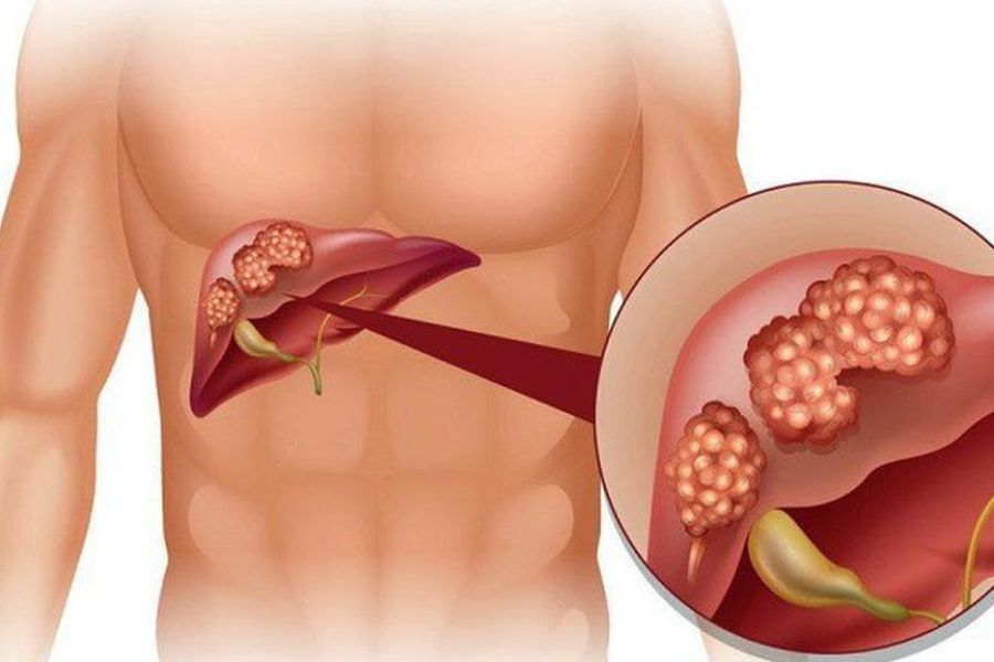 Bác sĩ chuyên khoa Gan mật tư vấn về mức độ an toàn và các biến chứng của u máu gan