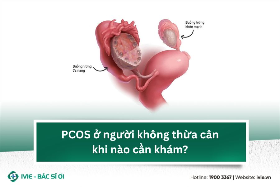 PCOS ở người không thừa cân khi nào cần khám?