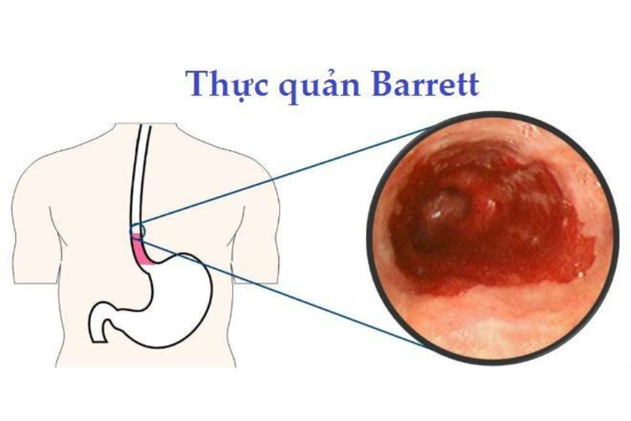 Sự biến đổi niêm mạc thực quản từ lành tính sang tổn thương dạng Barrett do tác động kéo dài của axit dạ dày trào ngược