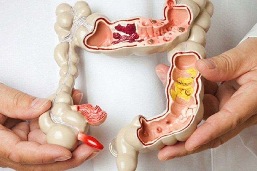 Các yếu tố nguy cơ làm tăng tỷ lệ mắc polyp đại tràng như tuổi tác, lối sống và tiền sử gia đình
