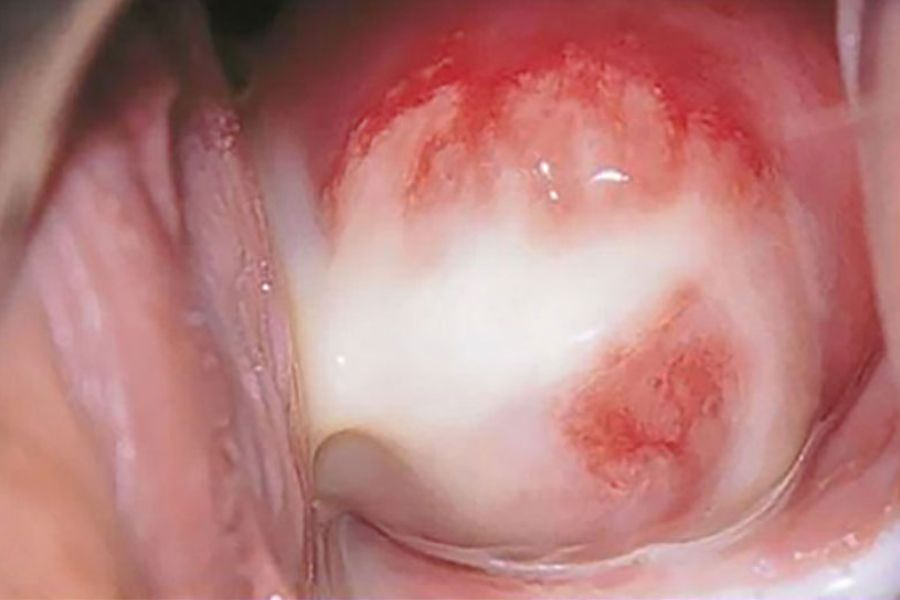 Nhận biết sớm các triệu chứng bất thường giúp chị em ngăn ngừa biến chứng nguy hiểm