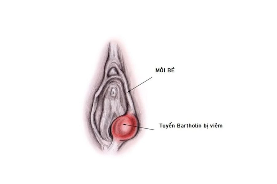 Nang tuyến Bartholin có thể phát triển to dần và gây viêm nhiễm nghiêm trọng nếu không được xử lý đúng cách