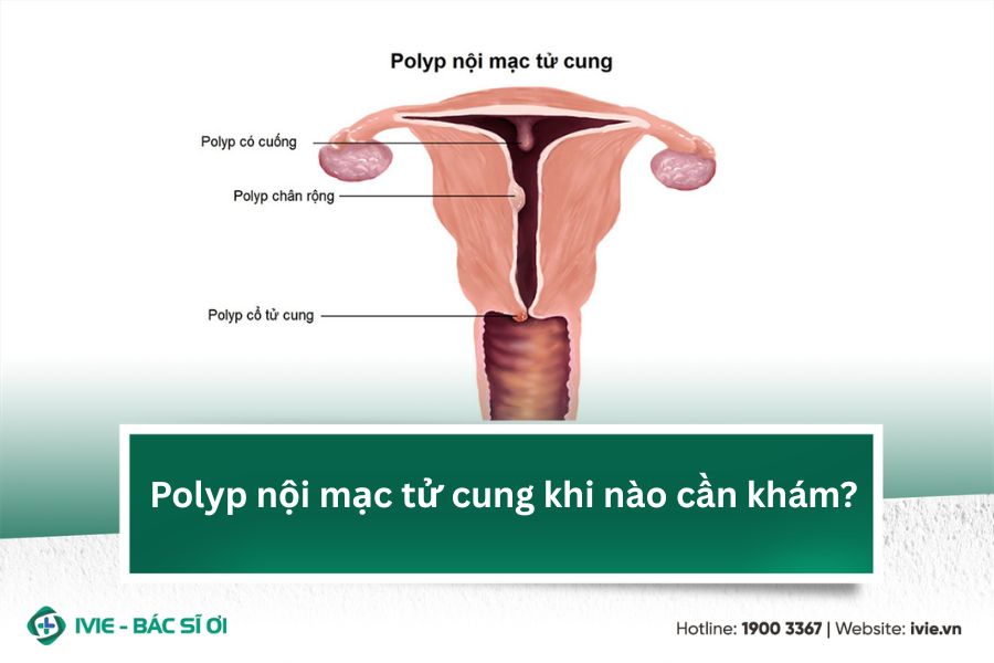 Polyp nội mạc tử cung khi nào cần khám?