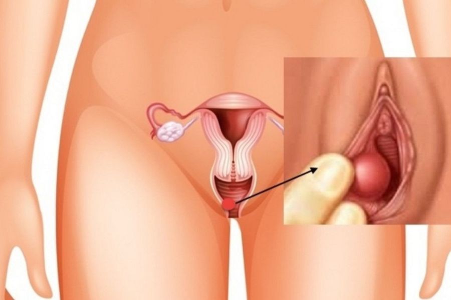 Áp xe tuyến Bartholin là ổ mủ do nhiễm trùng, thường gây sưng đau một bên gần cửa âm đạo