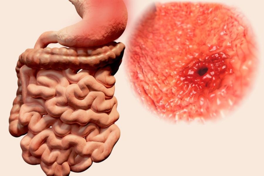 Crohn là bệnh viêm ruột mạn tính, thường ảnh hưởng đến ruột non và đại tràng, không lây từ người sang người