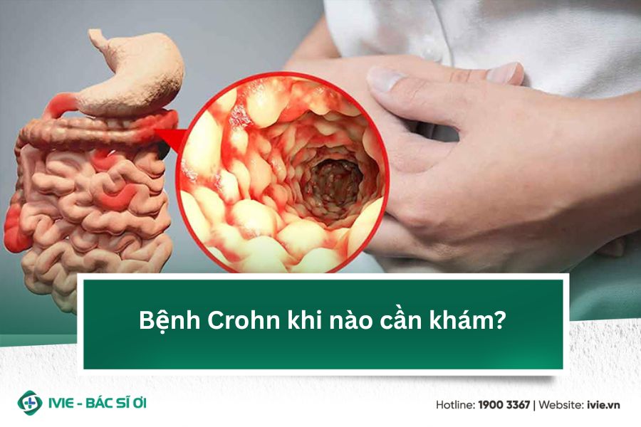 Bệnh Crohn khi nào cần khám?