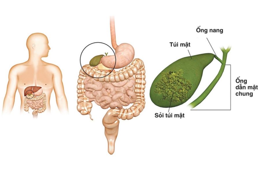 Sỏi túi mật không có triệu chứng thường được phát hiện tình cờ khi siêu âm ổ bụng hoặc kiểm tra sức khỏe