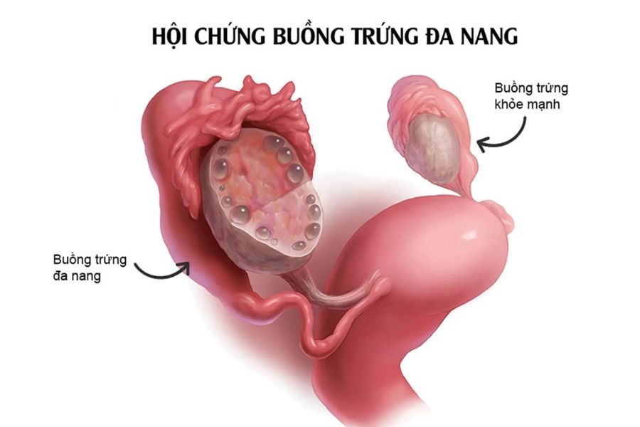 PCOS là rối loạn nội tiết thường gặp, có thể ảnh hưởng đến khả năng sinh sản và sức khỏe chuyển hóa