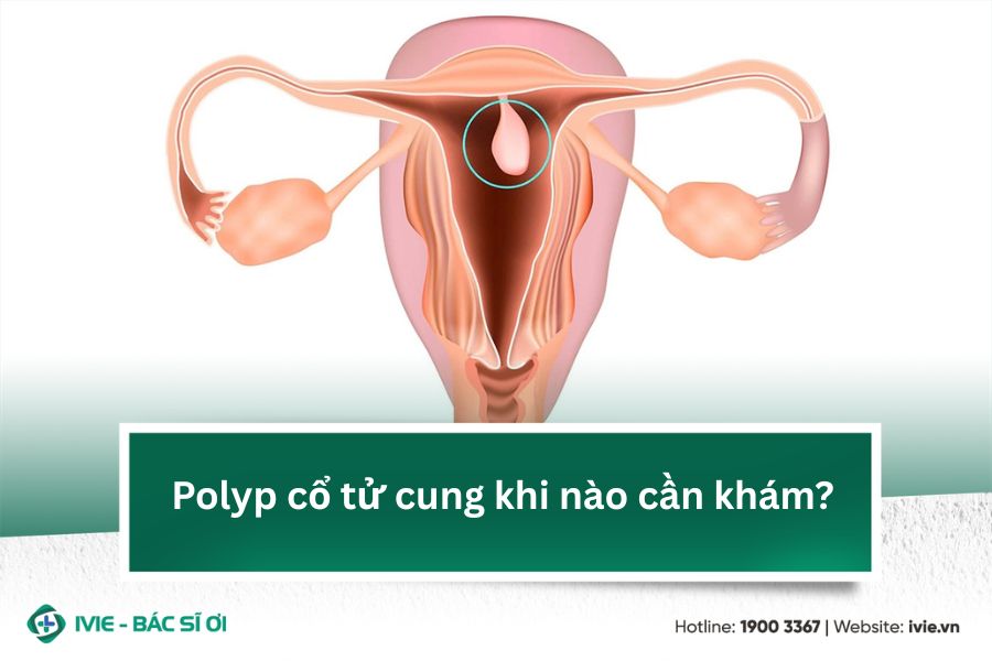 Polyp cổ tử cung khi nào cần khám?