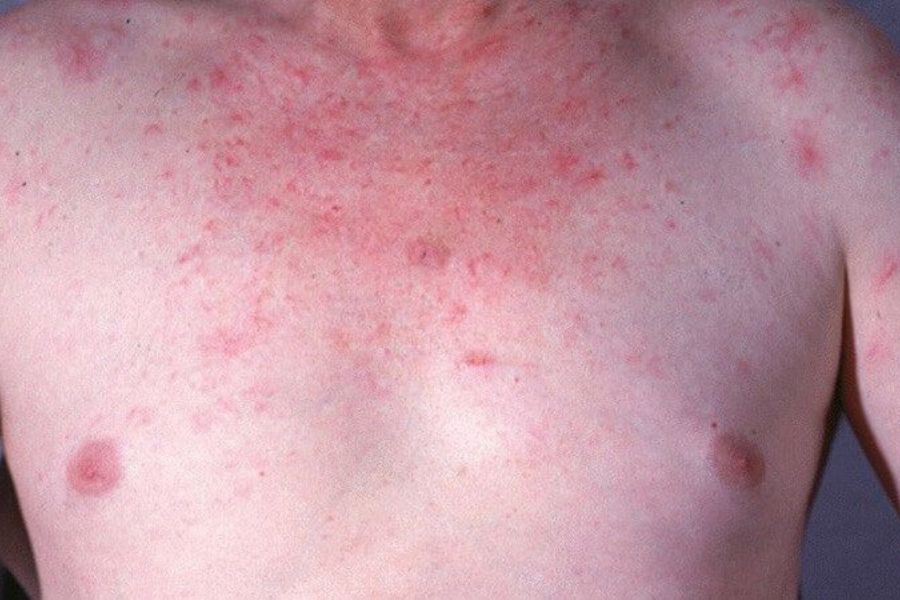 Dấu hiệu sao mạch trên da cổ và ngực - một trong những biểu hiện gợi ý xơ gan còn bù
