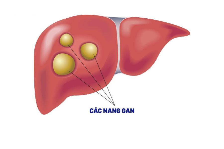 Nang gan thường là túi chứa dịch trong mô gan, phổ biến nhất là nang đơn thuần lành tính và ít gây triệu chứng