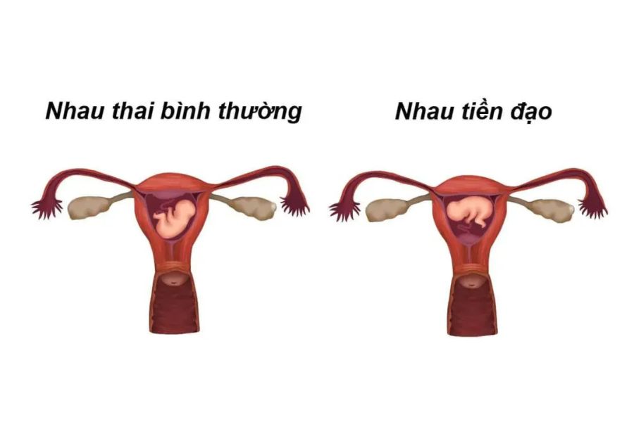 Nhau tiền đạo che lỗ trong cổ tử cung, còn nhau bám thấp nằm gần nhưng không che lỗ này