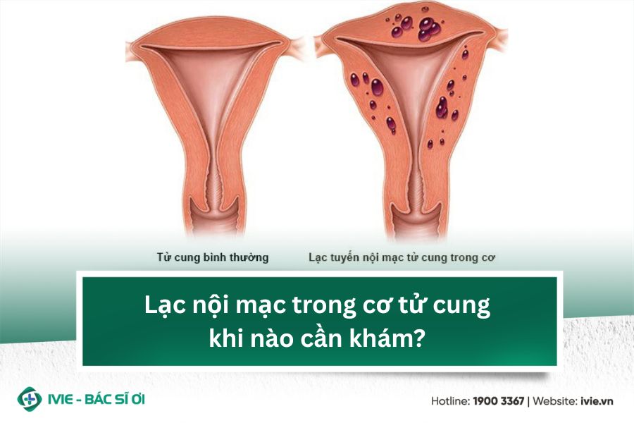 Lạc nội mạc trong cơ tử cung khi nào cần khám?