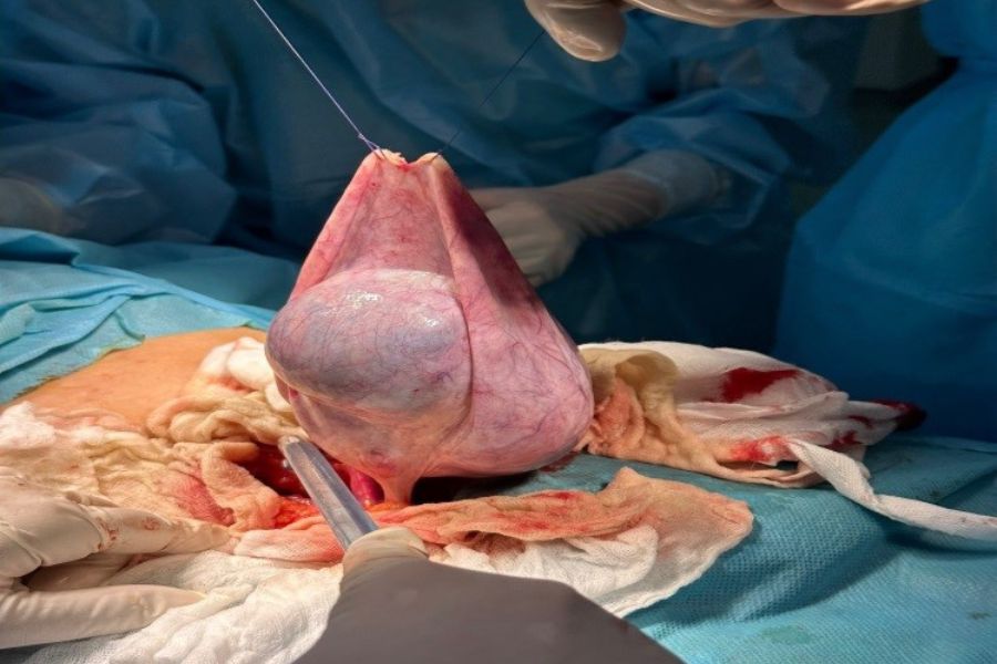 Kích thước lớn trên 5cm-8cm hoặc có biến chứng chèn ép là những chỉ định phẫu thuật bắt buộc