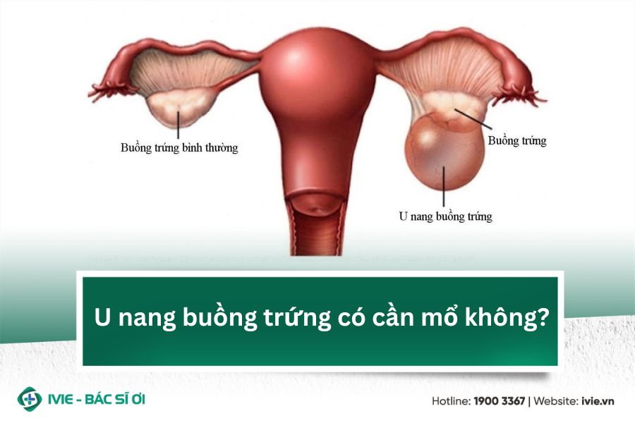 U nang buồng trứng có cần mổ không?