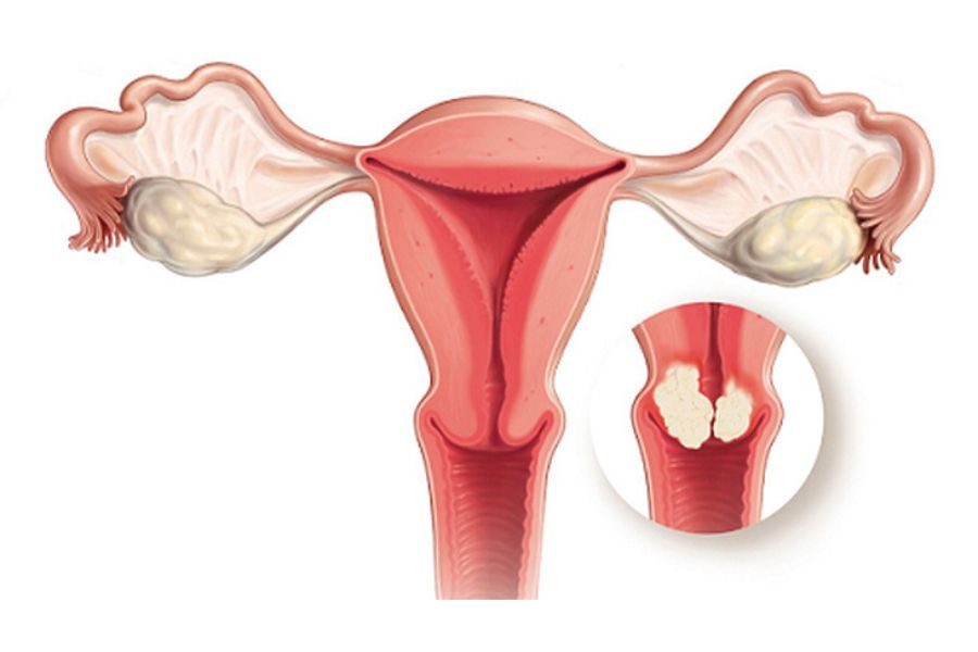 Polyp nội mạc tử cung phát triển từ lớp niêm mạc, còn u xơ phát triển từ lớp cơ tử cung