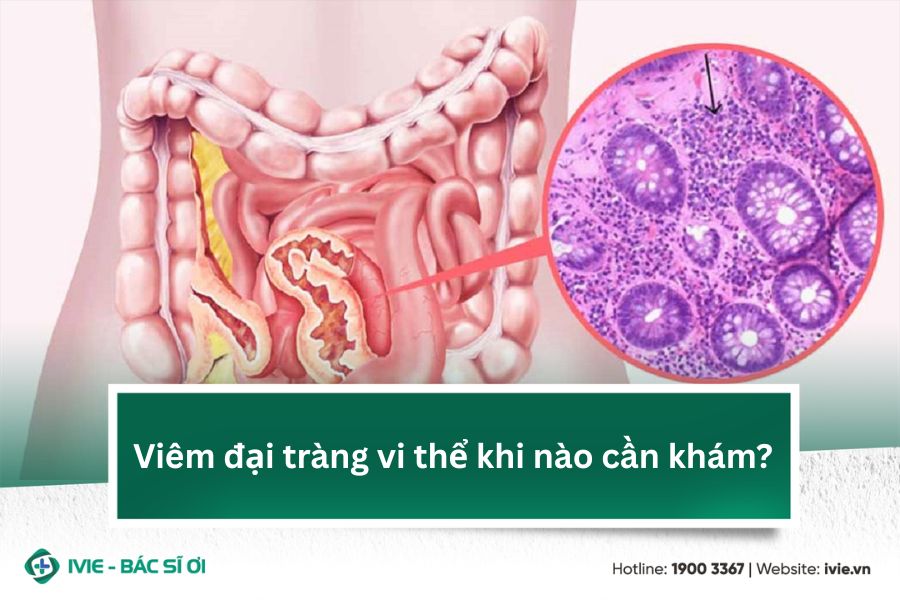 Viêm đại tràng vi thể khi nào cần khám?