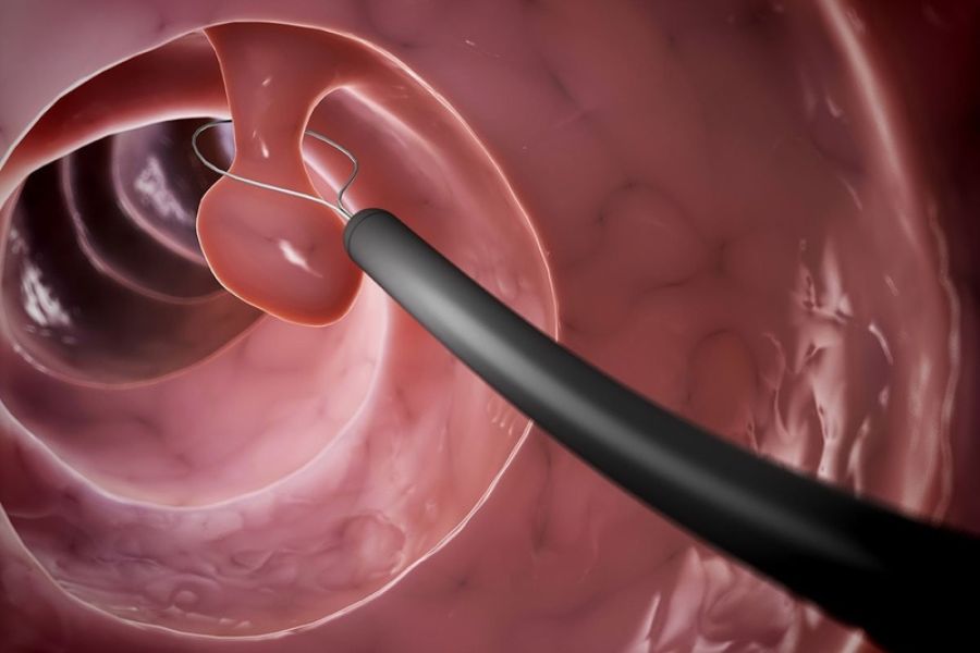 Polyp dạ dày là khối tăng trưởng trên niêm mạc, thường lành tính và được phát hiện qua nội soi