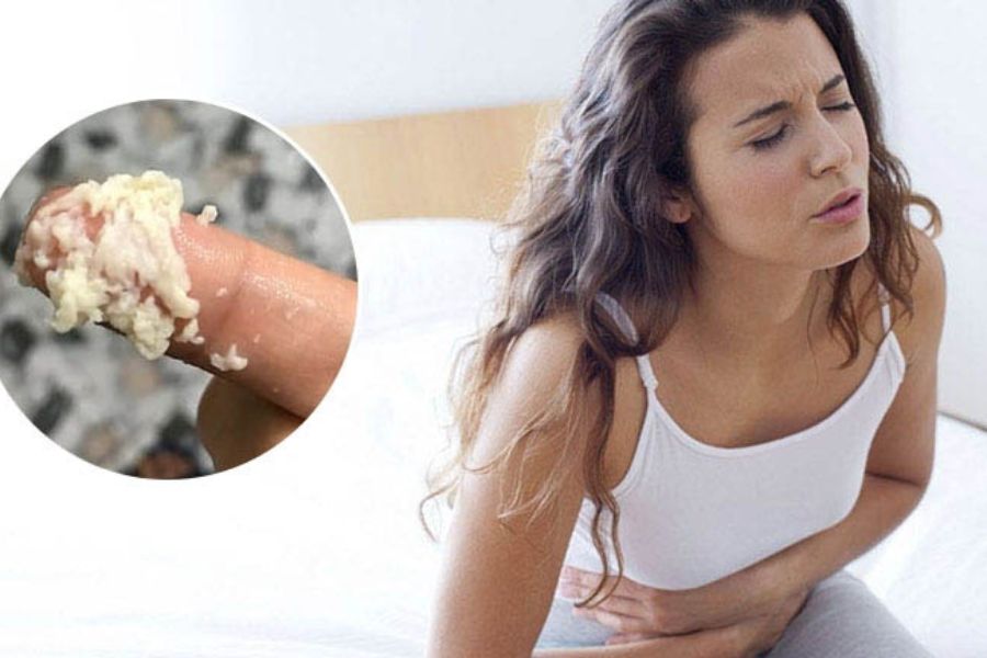 Nấm Candida và sự mất cân bằng hệ vi sinh âm đạo là nguyên nhân hàng đầu gây ra tình trạng khí hư vón cục như bã đậu