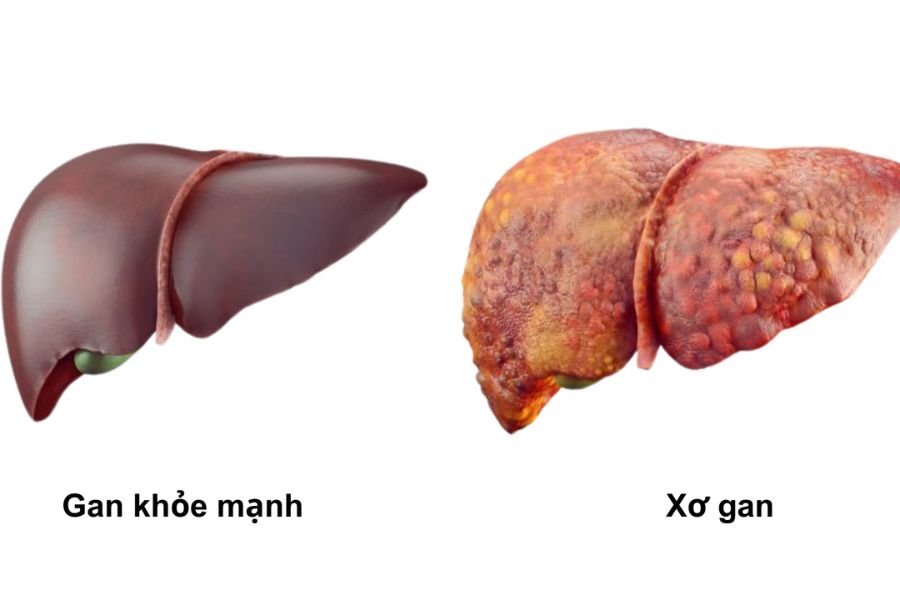 Các mô xơ sẹo một khi đã hình thành sẽ không thể tự phục hồi, nhưng điều trị sớm giúp bảo vệ phần gan lành còn lại