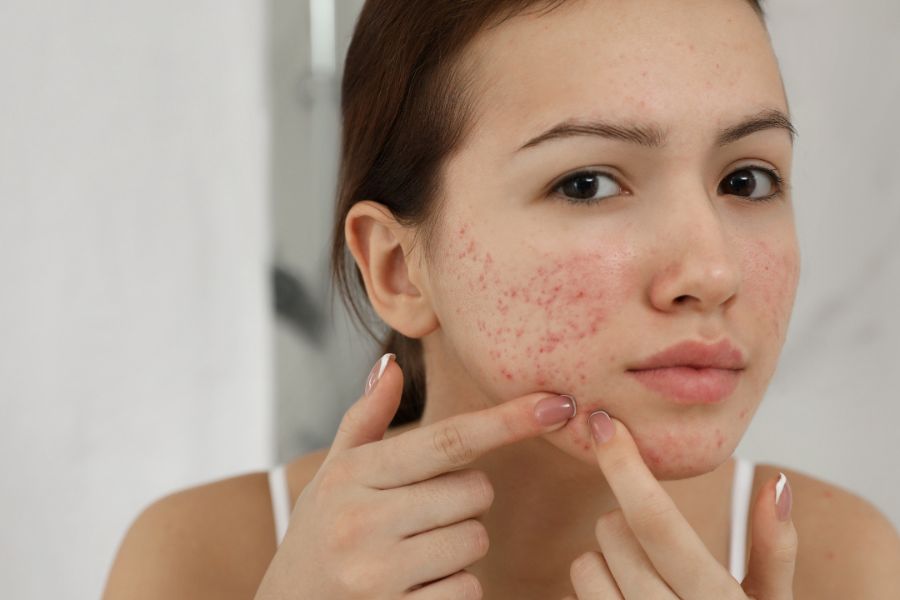 PCOS thể gầy vẫn có thể gây kinh nguyệt không đều, mụn dai dẳng, rậm lông và khó thụ thai