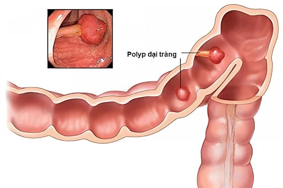 Đa số polyp đại tràng là lành tính, nhưng một số loại có thể tiến triển thành ung thư theo thời gian