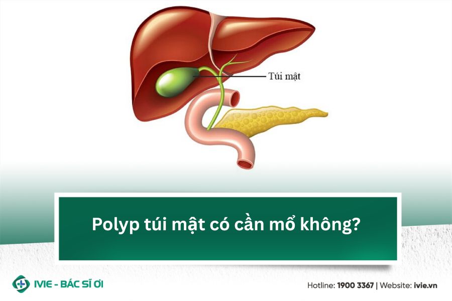 Polyp túi mật có cần mổ không?