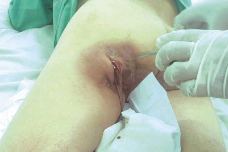 Tình trạng sưng đau cạnh hậu môn kéo dài kèm sốt là triệu chứng điển hình cần được thăm khám y tế sớm