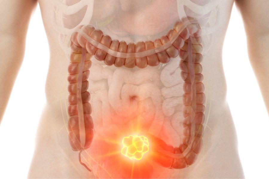 Phân nhỏ dẹt có thể liên quan đến táo bón, ruột kích thích hoặc bệnh lý hậu môn - trực tràng