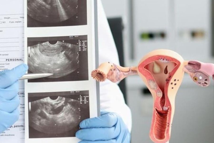Siêu âm và nội soi buồng tử cung giúp phát hiện, đánh giá polyp nội mạc tử cung