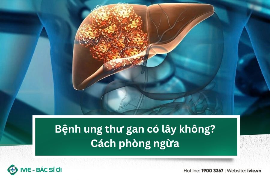 Bệnh ung thư gan có lây không? Cách phòng ngừa