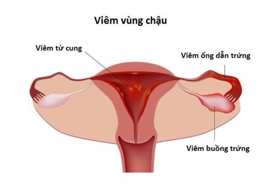 Bệnh lậu không được điều trị có thể gây viêm vùng chậu, tăng nguy cơ vô sinh và thai ngoài tử cung