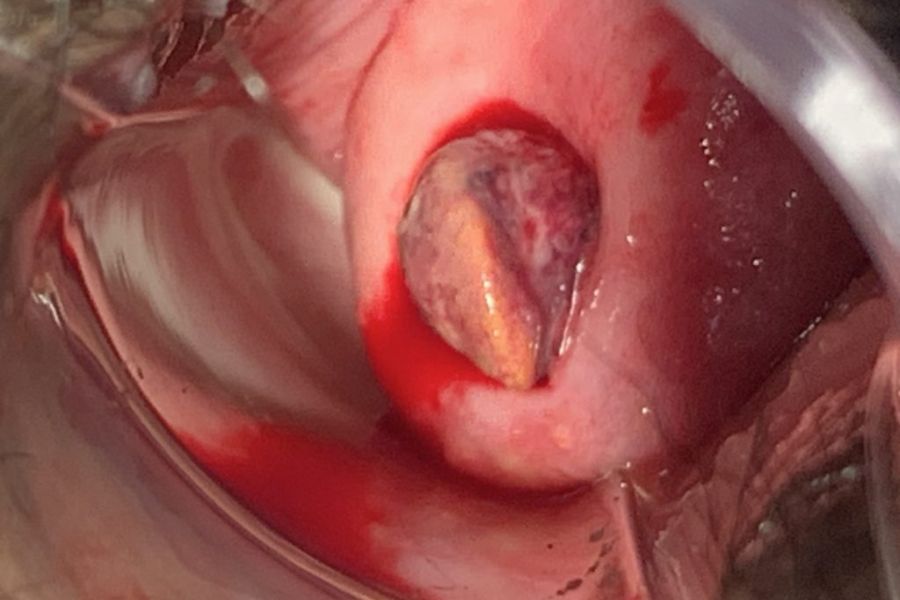 Chảy máu âm đạo bất thường và khí hư ra nhiều có thể là dấu hiệu polyp cổ tử cung