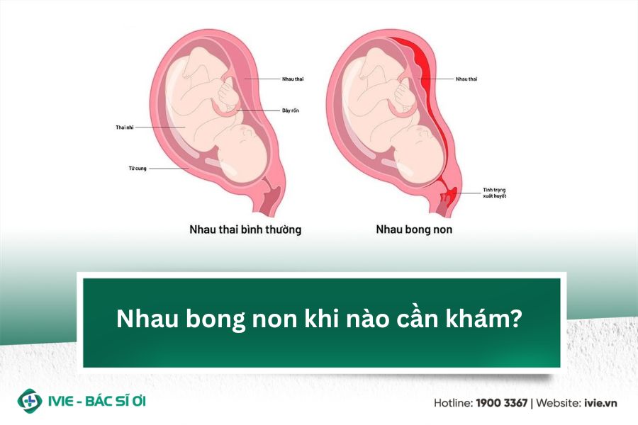 Nhau bong non khi nào cần khám?