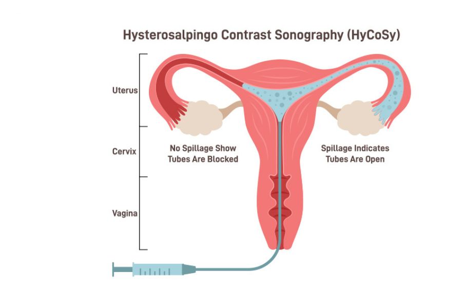 Chụp HSG và siêu âm HyCoSy giúp bác sĩ kiểm tra vòi trứng có thông hay bị tắc